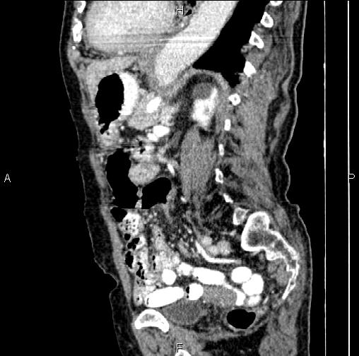 File:Aortic aneurysm and Lemmel syndrome (Radiopaedia 86499-102554 D 56).jpg