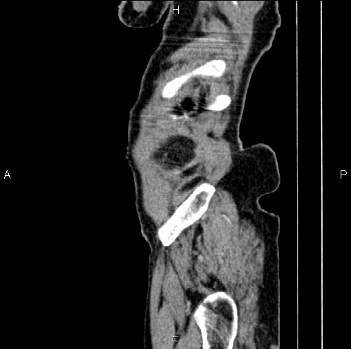 File:Aortic aneurysm and Lemmel syndrome (Radiopaedia 86499-102554 D 87).jpg