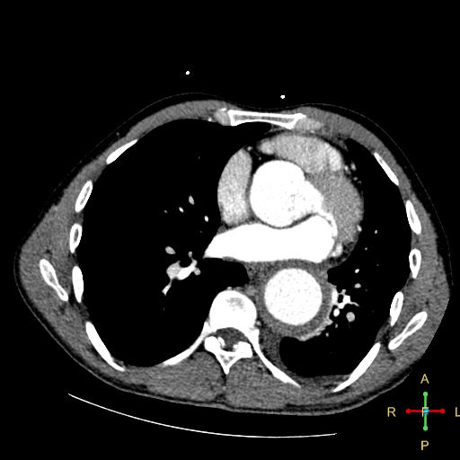 File:Aortic aneurysm and penetrating ulcer (Radiopaedia 23590-23704 A 20).jpg