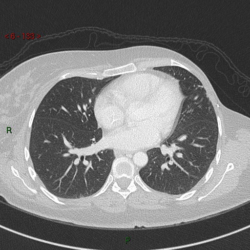 Aortic arch origin of left vertebral artery (Radiopaedia 51520-57286 Axial lung window 133).jpg