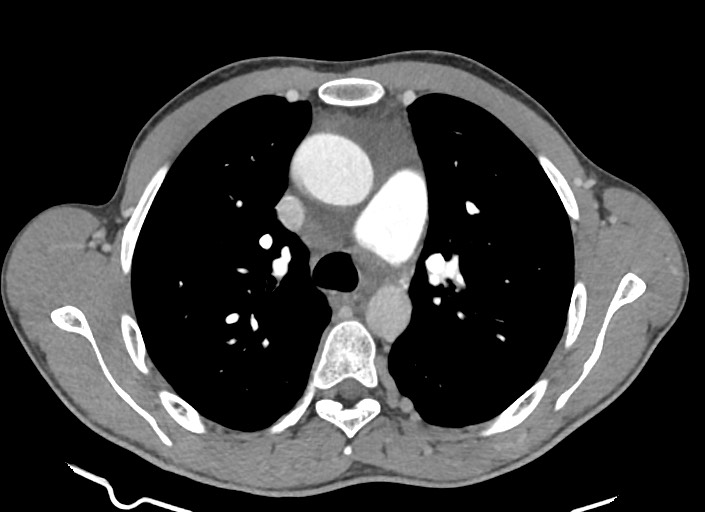 File:Aortic coarctation with aneurysm (Radiopaedia 74818-85828 A 133).jpg