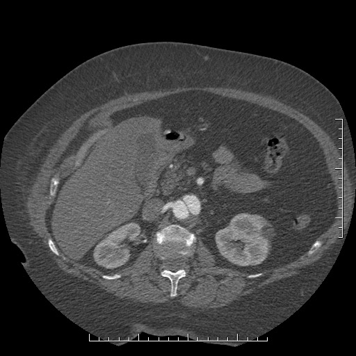 Aortic dissection- Stanford A (Radiopaedia 35729-37268 B 58).jpg