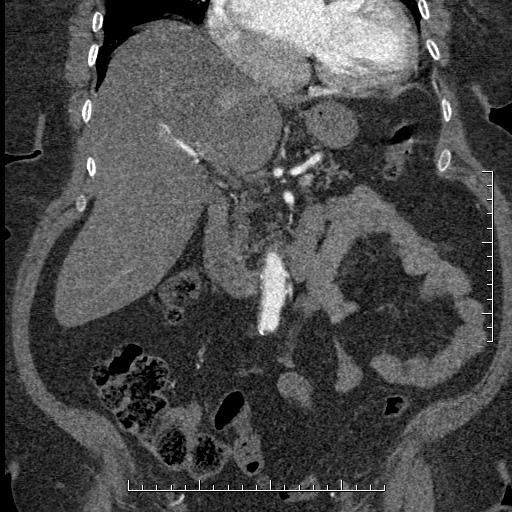 File:Aortic dissection- Stanford A (Radiopaedia 35729-37268 F 43).jpg