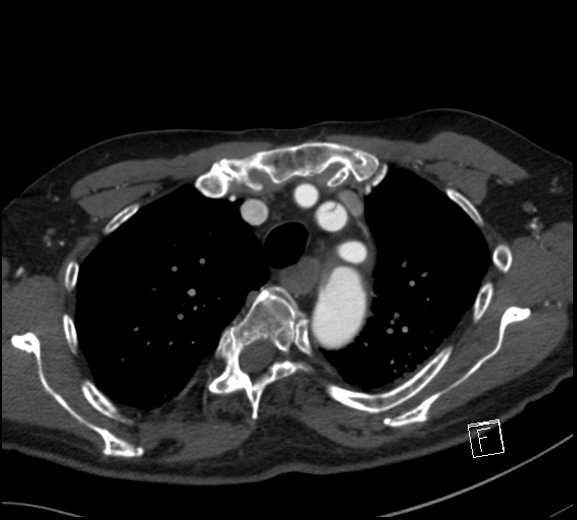 File:Aortic dissection (CTPA) (Radiopaedia 75506-86750 A 23).jpg