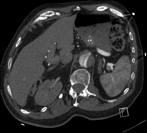 File:Aortic dissection (CTPA) (Radiopaedia 75506-86750 A 92).jpg