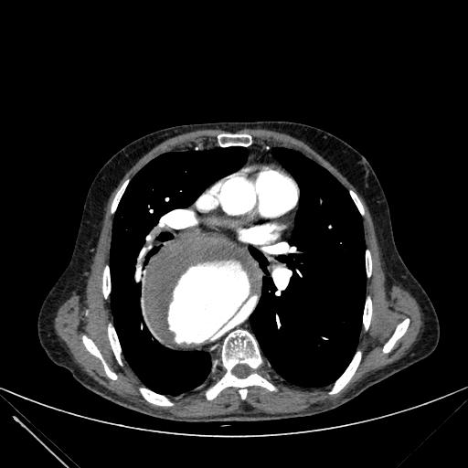 Aortic dissection (Radiopaedia 27466-27665 C+ arterial phase 127).jpg