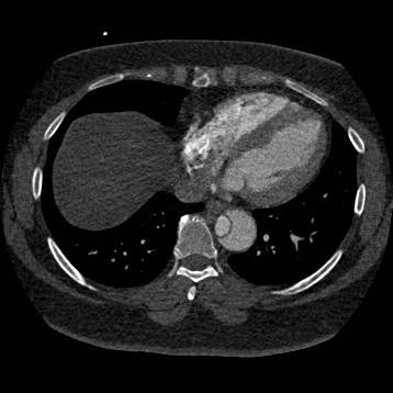 Aortic dissection (Radiopaedia 57969-64959 A 214).jpg