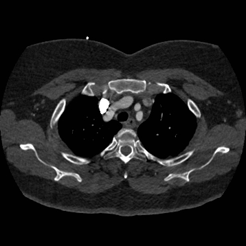 File:Aortic dissection (Radiopaedia 57969-64959 A 69).jpg