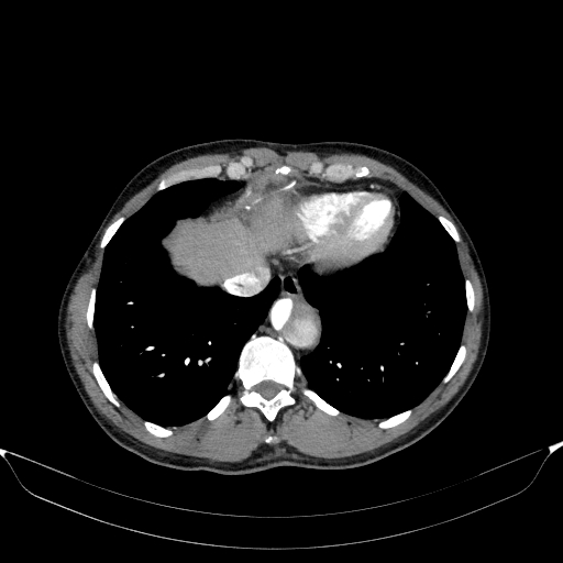 File:Aortic dissection - Stanford type A (Radiopaedia 83418-98500 A 51).jpg