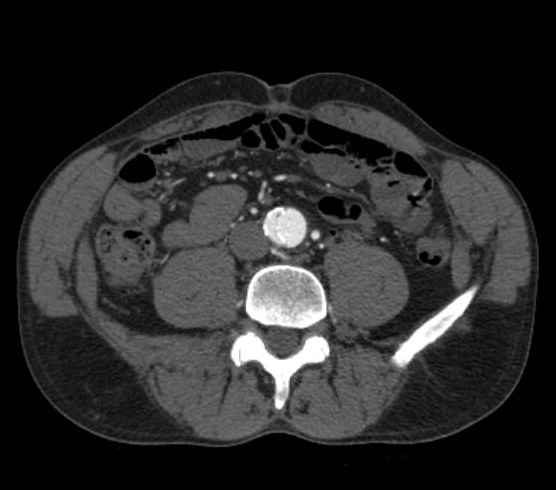 Aortic dissection - Stanford type B (Radiopaedia 73648-84437 A 191).jpg