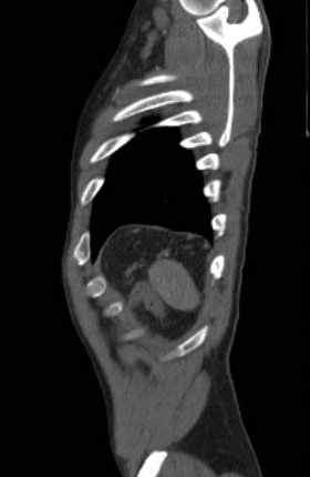 File:Aortic dissection - Stanford type B (Radiopaedia 73648-84437 C 11).jpg