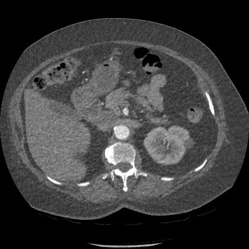 File:Aortic dissection - Stanford type B (Radiopaedia 88281-104910 A 111).jpg