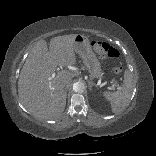 File:Aortic dissection - Stanford type B (Radiopaedia 88281-104910 A 99).jpg