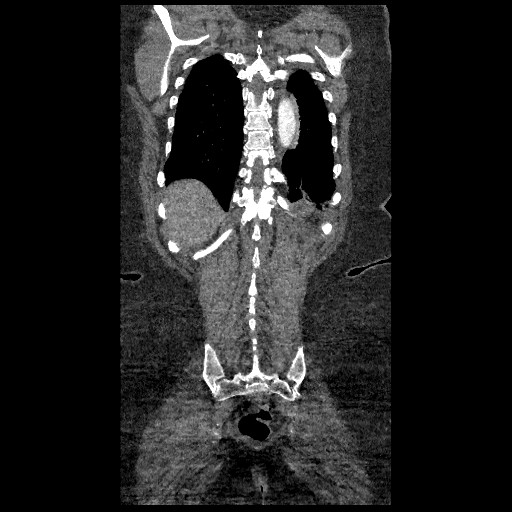 File:Aortic dissection - Stanford type B (Radiopaedia 88281-104910 B 76).jpg