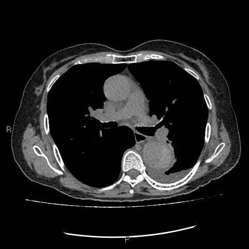 File:Aortic dissection extended to lusory artery (Radiopaedia 43686-47136 Axial non-contrast 13).jpg