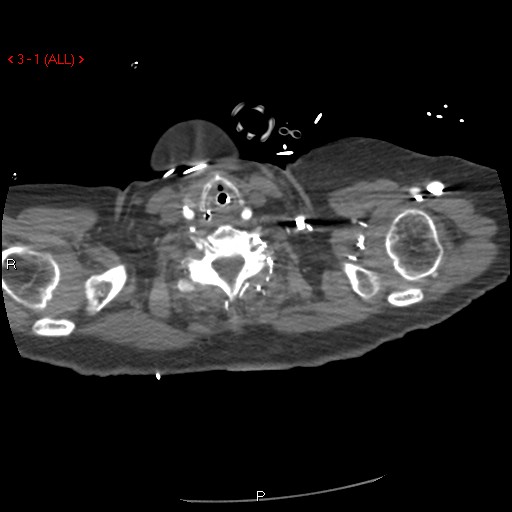 Aortic intramural hematoma (Radiopaedia 27746-28001 A 1).jpg