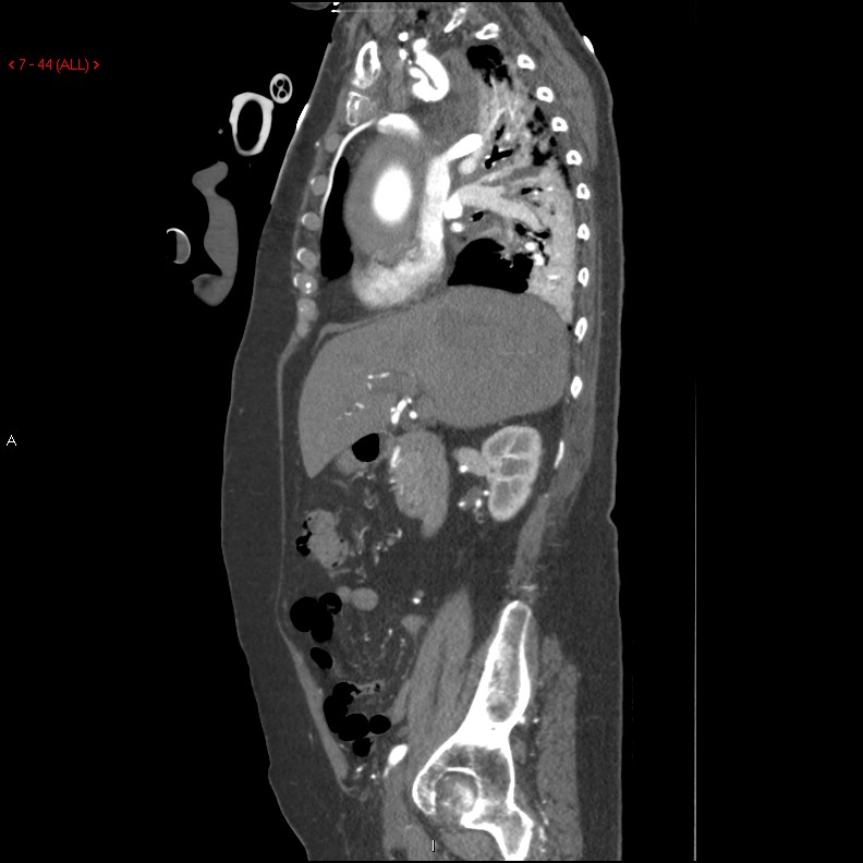 Aortic intramural hematoma (Radiopaedia 27746-28001 C 13).jpg