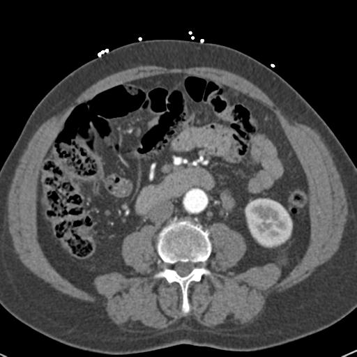 Aortic intramural hematoma (Radiopaedia 31139-31838 B 111).jpg