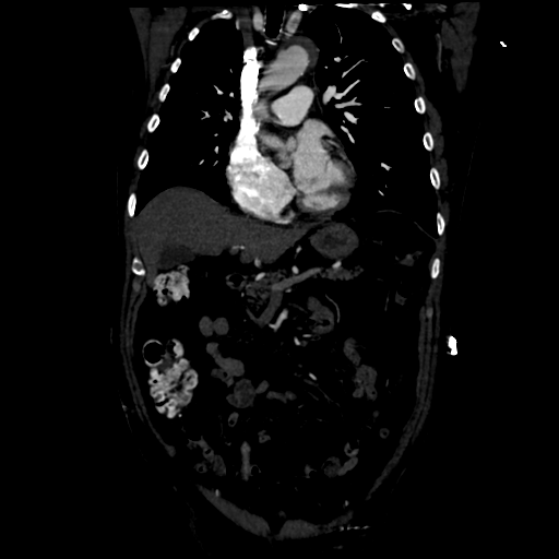 Aortic intramural hematoma (Radiopaedia 34260-35540 C 35).png