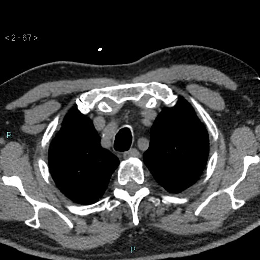 Aortic intramural hematoma (Radiopaedia 48463-53380 Axial non-contrast 29).jpg