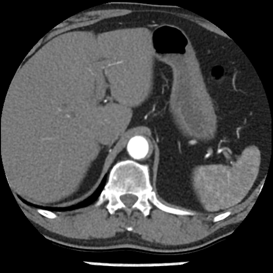 Aortic intramural hematoma (type B) (Radiopaedia 79323-92387 B 54).jpg