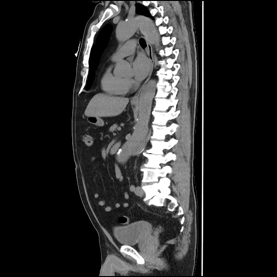 Aortic intramural hematoma (type B) (Radiopaedia 79323-92387 G 28).jpg