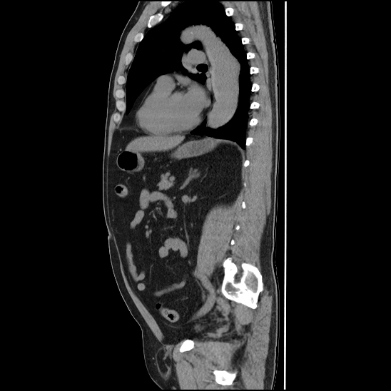 Aortic intramural hematoma (type B) (Radiopaedia 79323-92387 G 33).jpg
