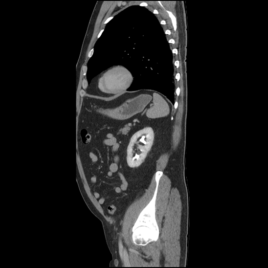 Aortic intramural hematoma (type B) (Radiopaedia 79323-92387 Sagittal C+ delayed 42).jpg