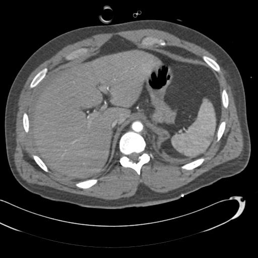 Aortic transection, diaphragmatic rupture and hemoperitoneum in a complex multitrauma patient (Radiopaedia 31701-32622 A 82).jpg
