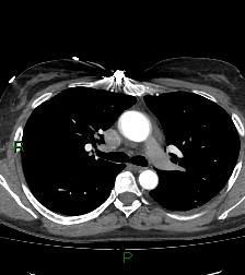 Aortic valve endocarditis (Radiopaedia 87209-103485 C 37).jpg