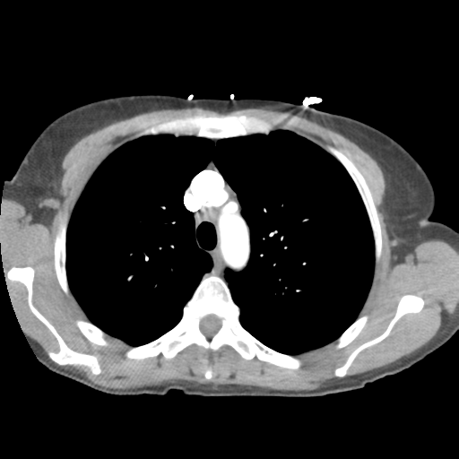 File:Aortic valve non-coronary cusp thrombus (Radiopaedia 55661-62189 B 14).png