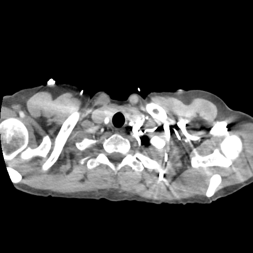 Aortic valve non-coronary cusp thrombus (Radiopaedia 55661-62189 B 4).png