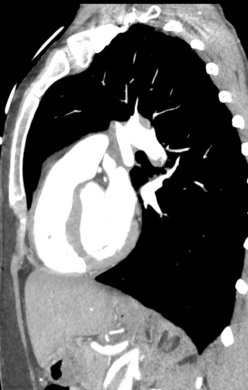 Aortic valve non-coronary cusp thrombus (Radiopaedia 55661-62189 C+ arterial phase 21).png