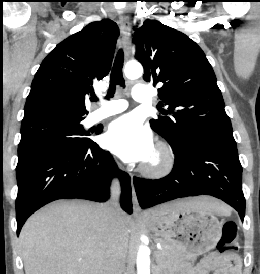 File:Aortic valve non-coronary cusp thrombus (Radiopaedia 55661-62189 C 41).png