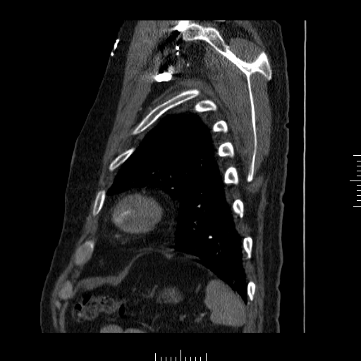 File:Aorto-coronary bypass graft aneurysms (Radiopaedia 40562-43157 C 37).png