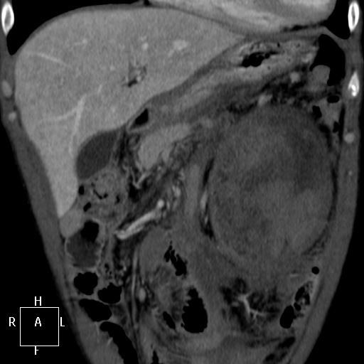 Aorto-left renal vein fistula (Radiopaedia 45534-49628 B 8).jpg