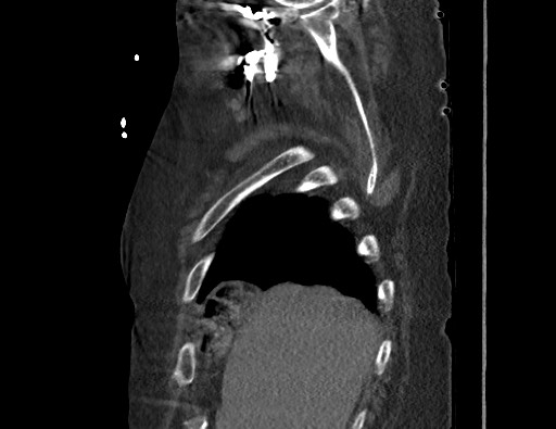 Aortoesophageal fistula with endovascular repair (Radiopaedia 73781-84592 Sagittal C+ CTPA 16).jpg