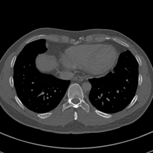 Apical lung mass mimic - neurogenic tumor (Radiopaedia 59918-67521 Axial bone window 61).jpg