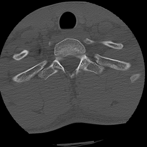 Apical pneumothorax on cervical spine CT (Radiopaedia 45343-49368 Axial bone window 82).jpg