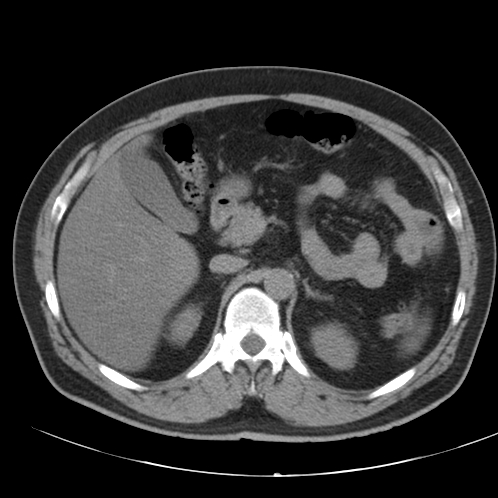 Appendicitis and giant appendicolith (Radiopaedia 80251-93588 Axial non-contrast 14).jpg