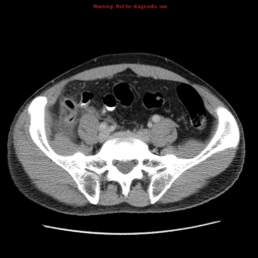 Appendicitis and renal cell carcinoma (Radiopaedia 17063-16760 A 42).jpg