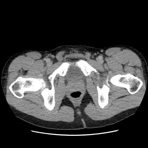File:Appendicitis complicated by post-operative collection (Radiopaedia 35595-37113 A 80).jpg