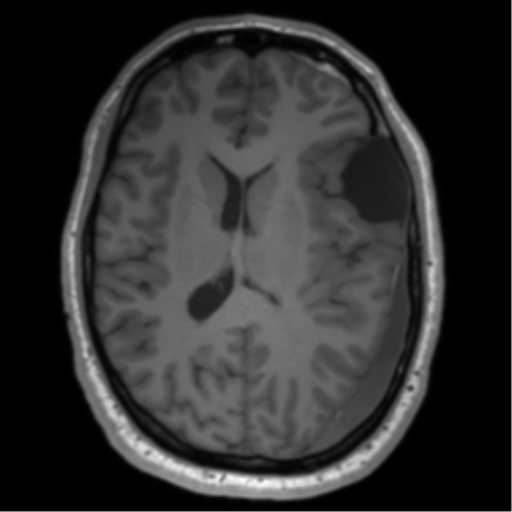 File:Arachnoid cyst with subdural hematoma (Radiopaedia 85892-101743 Axial T1 52).png