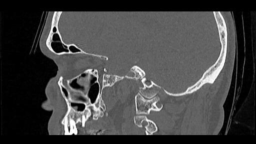 Arcuate foramen (Radiopaedia 89833-106944 Sagittal bone window 22).jpg