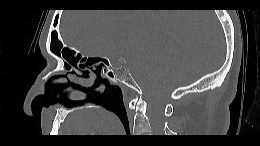 Arcuate foramen (Radiopaedia 89833-106944 Sagittal bone window 64).jpg