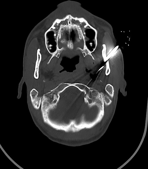 Arrow injury to the face (Radiopaedia 73267-84011 Axial bone window 39).jpg