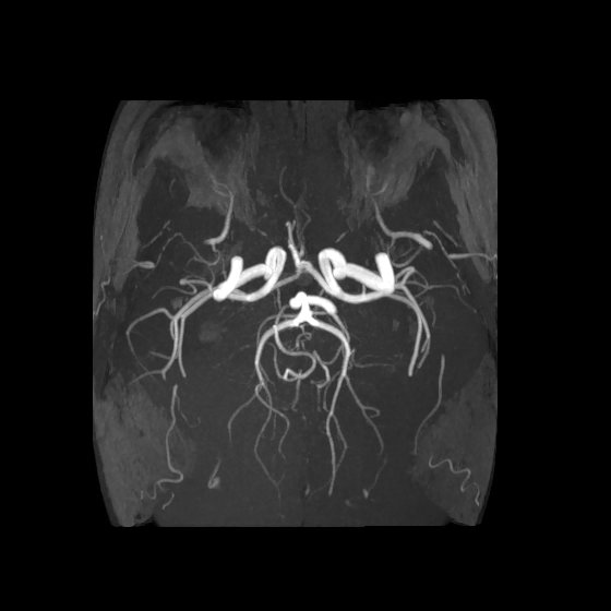 Artery of Percheron infarct (Radiopaedia 40966-43676 F 39).jpg