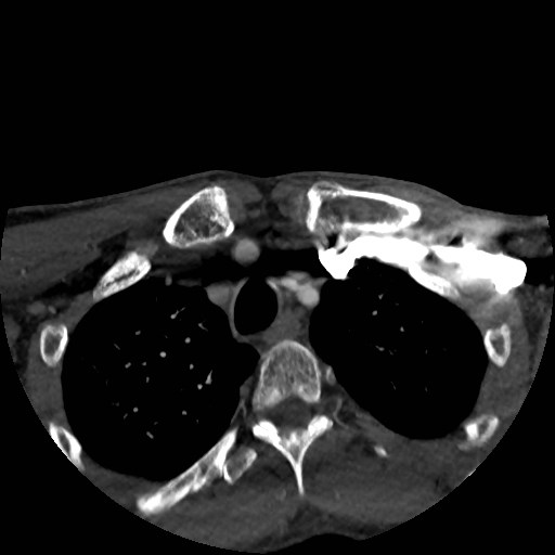 Artery of Percheron infarct (Radiopaedia 48088-52894 A 18).jpg