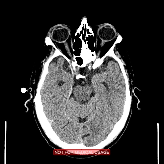 Artery of Percheron infarction (Radiopaedia 28679-28967 Axial non-contrast 43).jpg