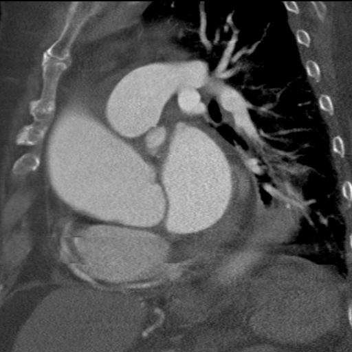 File:Ascending aortic aneurysm (Radiopaedia 20913-20846 A 13).jpg